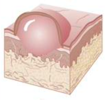 <p>has a roof cavity <span style="color: red;">more resistant to rupture</span></p><p>deep seated, larger than vesicles <span style="color: red;">greater than<strong> 0.5cm</strong></span></p><p>rubbing of non-vesiculated area may result in a formation to a vesicles or denudation of the mucosa or epidermis. (<span style="color: red;">nikolsky sign</span>) + to stippling off epithelium</p>