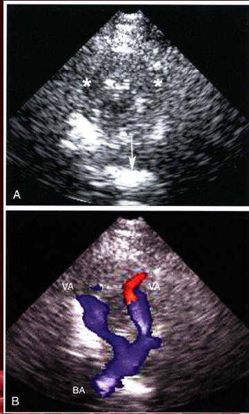 <p><strong>distal vertebral artery</strong></p><p><strong>basilar artery</strong><br></p><p>** in asterick is the foramen magnum</p>