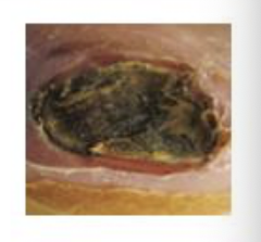 <p>Eschar (REALLY thick, leathery scab that affects the healing process)</p>