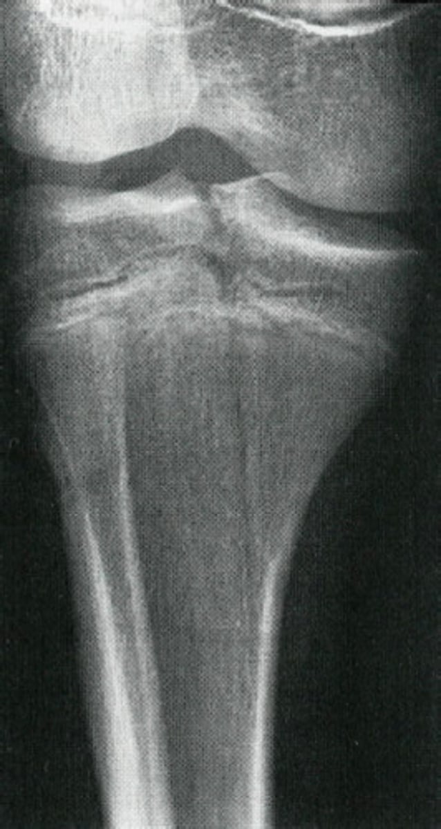 <p>physeal plate fracture with metaphyseal & epiphyseal fracture</p>