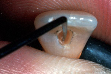 <p>After extending the access prep into the pulp chamber. Use this instrument to explore the pulp chamber and check for pulp horns</p>