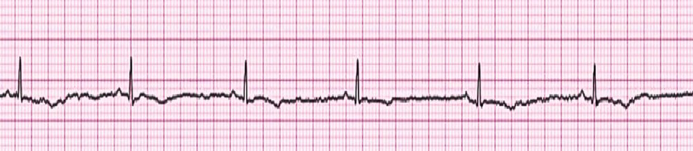 <p><span>The _________ arrhythmia is characterized by no palpable pulse or electrical activity. Compressions are required for this arrhythmia. Please name the arrhythmia shown below. </span></p>