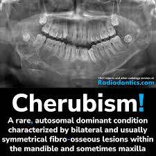 <p>soap bubbles or multilocular appearance</p>