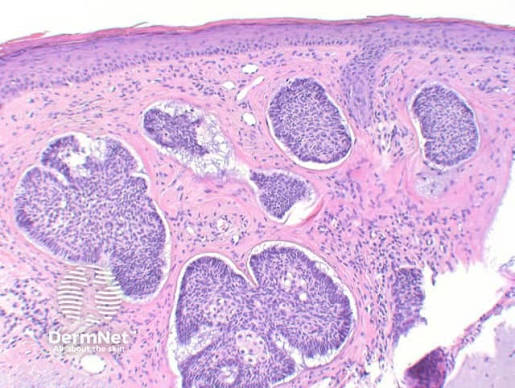 <p>histo: Nests of <strong>basaloid cells with peripheral palisading</strong></p>