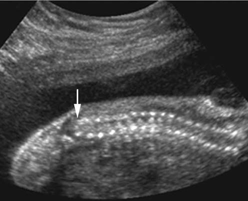 <p>more common with diabetes</p><ul><li><p>absent sacrum</p></li><li><p>fused pelvis </p></li><li><p>short femur </p></li></ul><p></p>