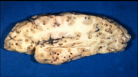 <p>Identifique a doença e cite sua forma de transmissão </p>