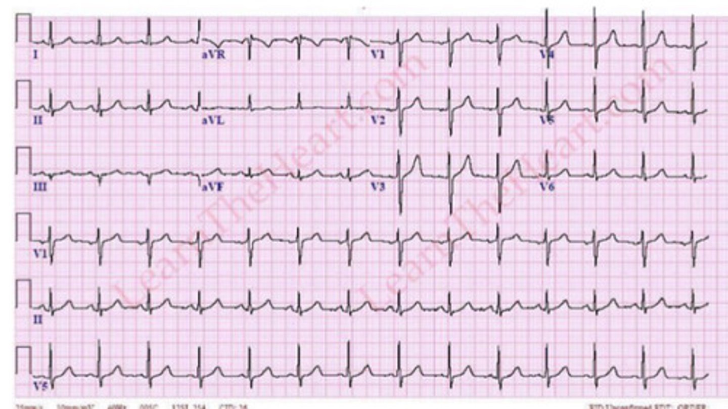 <p>is this normal, left, or right axis deviation? why</p>