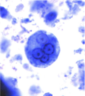 <ul><li><p>causes amebiasis </p></li></ul><p></p>