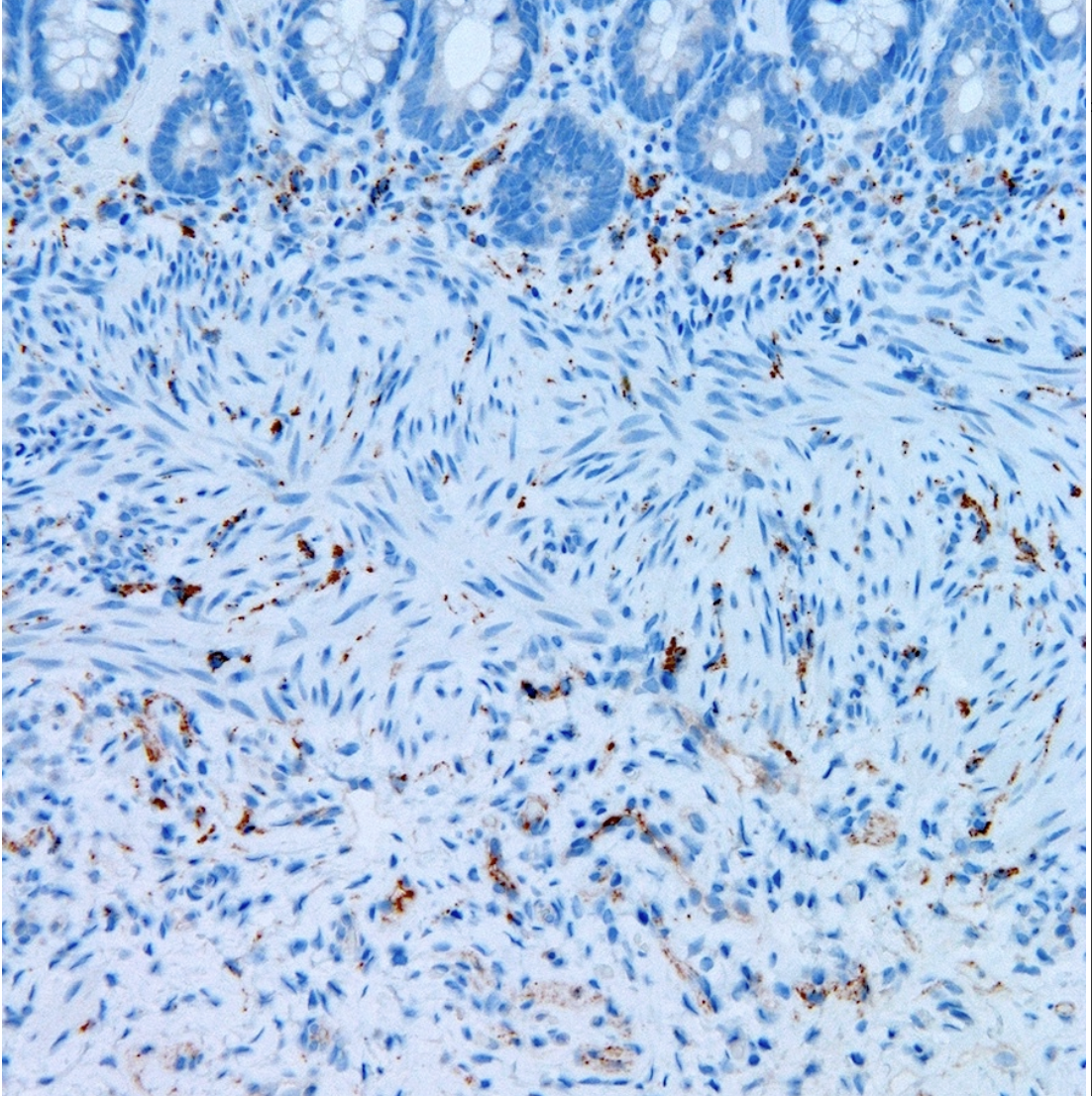 <p>in hirschsprung disease</p>