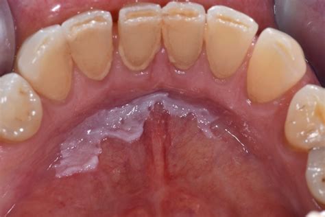 <p>Oral leukoplakia</p>