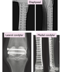 <p>What is the prognosis for 3rd metacarpal fractures?</p>