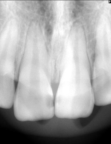 <p><span style="font-family: Calibri, sans-serif;"><strong>Forklar hvorledes radioluscente og radiopake områder er opstået på denne optagelse.&nbsp;</strong></span></p>