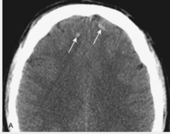<p>multiple areas of high attenuation hemorrhage w/in brain parenchyma on CT</p>