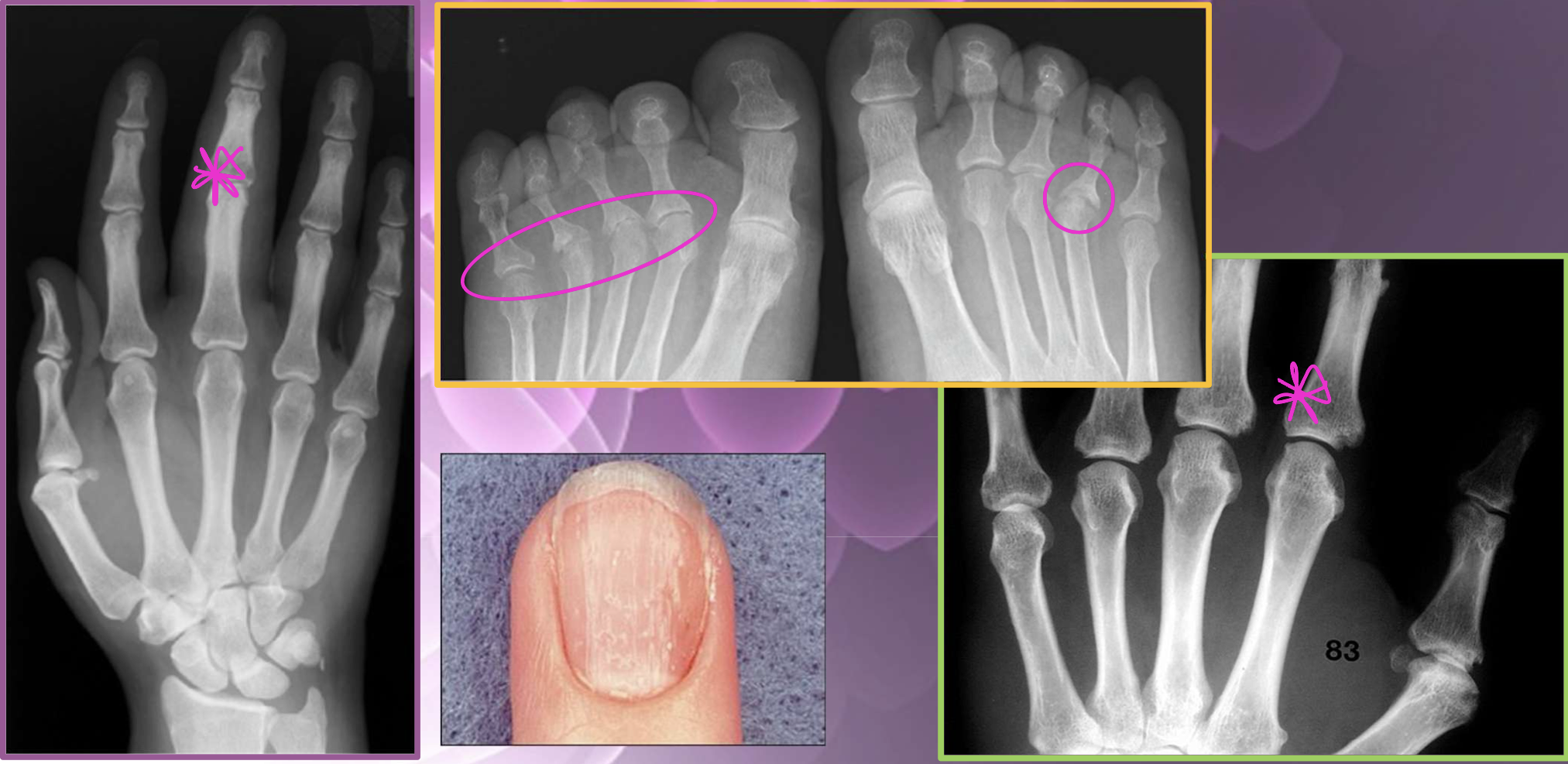 <p>What type of characterisitcs of PsA are found in this image</p>