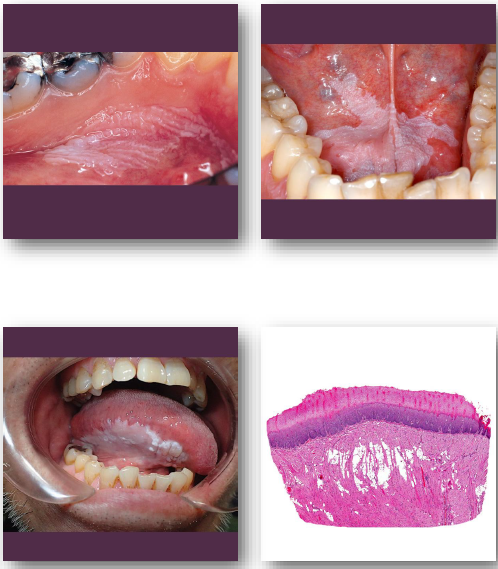 <p>• Biopsy required to evaluate degree of dysplasia</p><p>•Eliminate risk factors such as tobacco use</p><p>•Surgical removal for dysplastic lesions</p><p>•Requires regular follow-up and monitoring</p><p>•Variable malignant transformation risk exists</p>