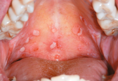 <p>type of papules that has <span style="color: red;">malignant lesion</span></p>