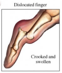 <p>complete disruption in normal relationship of articular surfaces of bones comprising a joint</p>