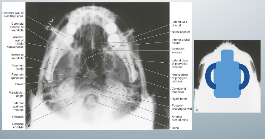 <p>-”jug handle view” because zygomatic arches stand out like the handles of a jug handle</p><p>-used for zygomatic arch fracture evaluation</p><p>-underexposure recommended to visualize zygomatic arches well</p>