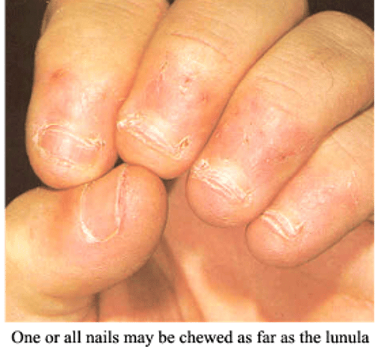 <p>nail biting</p>