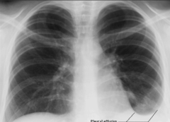 <p>What does the patient's left lung show?</p>