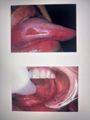 <p>Caused by: Cheek lip or tongue biting, denture irritation, mucosal injury, or overzealous brushing</p><p>TX: heals within 7-14 days unless trauma persists. </p><p>May require biopsy</p>