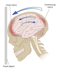 <p>What are the features of intraparenchymal hemorrhage due to trauma (contusions)?</p>
