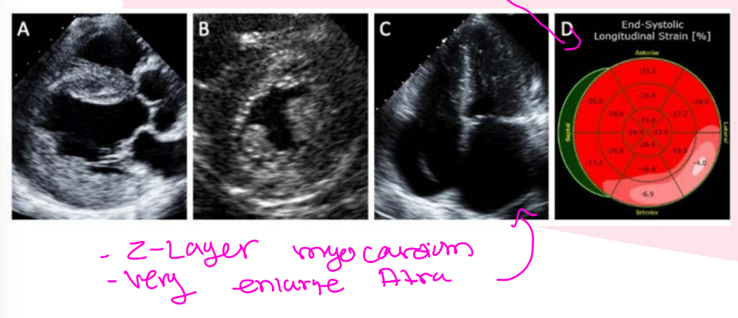 <ol><li><p>Short PR interval</p></li><li><p>Can present like any HCM phenotype</p></li><li><p>No significant differences in LVH, EF, LAVI, or GLS</p></li><li><p>Typically concentric LVH</p></li><li><p>Papillary hypertrophy</p></li><li><p>Worse LA strain</p></li><li><p>****LV strain pattern usually worse in the basal inferolateral wall**** (and the rest of the walls are normal so you know its Fabry DIsease)</p></li><li><p>Binary myocardium</p></li></ol><p></p><p><strong>Binary myocardium</strong> means the heart muscle looks like it has <strong>two different layers/textures</strong> on echo.</p><p>In <strong>Fabry disease</strong>, the myocardium can sometimes look like:</p><p><strong>1. A bright inner layer near the endocardium</strong><br>and<br><strong>2. A darker outer layer of myocardium</strong></p><p>That “two-layer look” is why they call it <strong>binary</strong> myocardium</p><p></p><p>“<strong>Presents like any HCM phenotype</strong>” means <strong>Fabry disease can look like regular HCM on echo</strong>.</p><p>A <strong>phenotype</strong> means the <strong>pattern/appearance</strong> of the disease.</p><p>So the slide is saying:</p><p><strong>Fabry disease can show up with the same types of heart-thickening patterns that HCM can show.</strong><br>For example, it may look like:</p><ul><li><p>septal hypertrophy</p></li><li><p>concentric LVH</p></li><li><p>papillary muscle hypertrophy</p></li><li><p>abnormal strain patterns</p></li></ul><p>That is why it is called an <strong>HCM phenocopy</strong> — it <strong>copies/mimics the appearance of HCM</strong>, even though the cause is different.</p><p>The next part, <strong>“no significant differences in LVH, EF, LAVI, GLS,”</strong> means the echo measurements may not clearly separate Fabry from regular HCM:</p><ul><li><p><strong>LVH</strong> = left ventricular hypertrophy/thick heart muscle</p></li><li><p><strong>EF</strong> = ejection fraction/pumping function</p></li><li><p><strong>LAVI</strong> = left atrial volume index</p></li><li><p><strong>GLS</strong> = global longitudinal strain</p></li></ul><p></p>