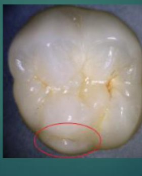<p>An addition cusp on molars, <span>extra bump on one or two of your teeth</span></p>