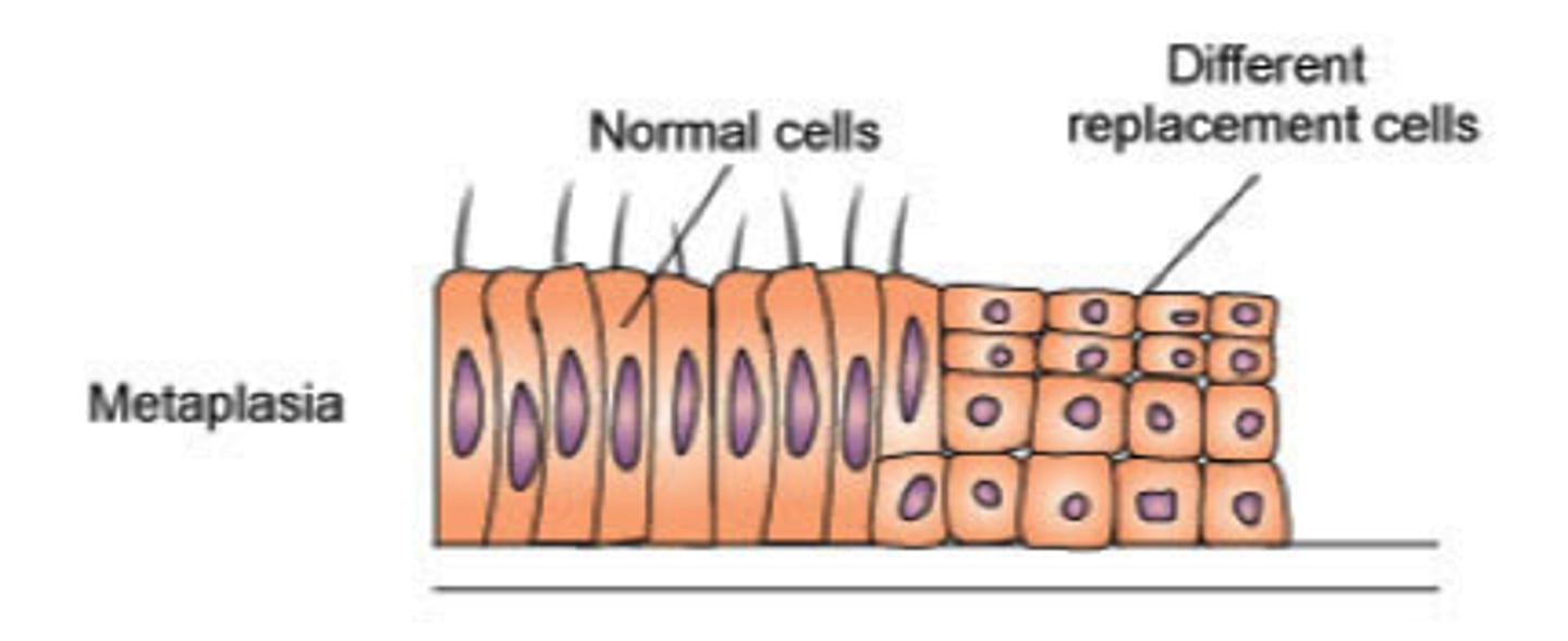 <p>when one mature cell type is replaced by a different mature cell type. ex: change in respiratory tracts in cigarette smokers.</p>
