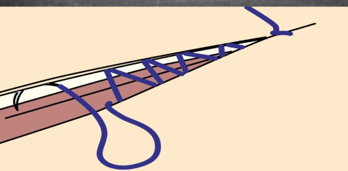 <p><span><strong>How to do it:</strong></span></p><ul><li><p><span>Continuous suture placed <strong>within the dermis</strong>, running parallel to wound.</span></p></li><li><p><span>No external stitches.</span></p></li></ul><p><span><strong>Entry/Exit:</strong></span></p><ul><li><p><span>Enter at one end of wound → weave through dermis → exit at opposite end.</span></p></li></ul><p><span><strong>Important:</strong></span></p><ul><li><p><span>Best cosmetic closure.</span></p></li><li><p><span>No eversion needed.</span></p></li><li><p><span>Common in <strong>facial</strong> or <strong>clean surgical</strong> wounds.</span></p></li></ul><p></p>