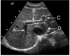 <p>The arrow labeled D is pointing to what lobe of the liver?</p><p>a. medial segment of left lobe </p><p>b. lateral segment left lobe</p><p>c. posterior segment right lobe</p><p>d. anterior segment right lobe</p><p>e. caudate lobe</p>