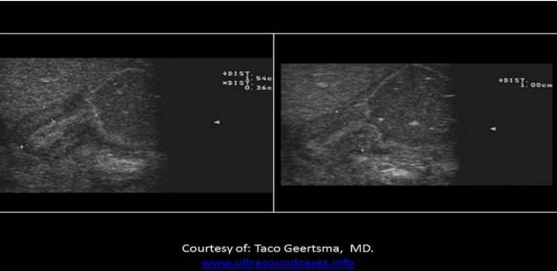 <p>Which of the following is true regarding the image of the RUQ of a neonate?</p><p>A. The pylorus is thickened and the stomach is demonstrated medially.</p><p class="p1">B. The pylorus is thickened with an adjacent solid mass.</p><p class="p1">C. The pylorus is not thickened but there is a fluid collection seen in the stomach.</p><p class="p1">D. The pylorus and the stomach are both demonstrated normally on the image.</p>