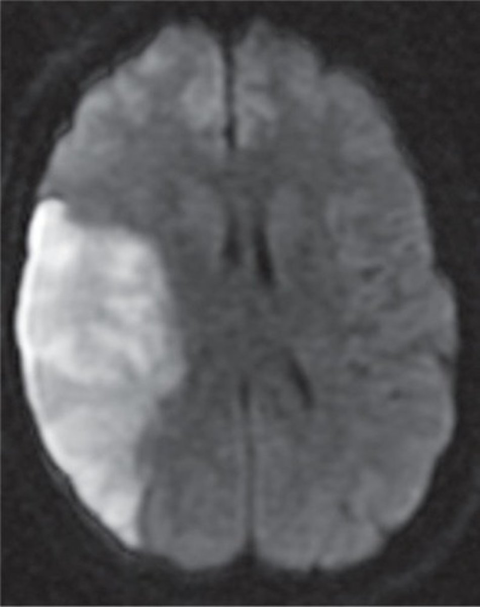 <p>stroke identification</p><p>-highly sensitive for finding recent infarcts</p>
