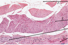 <p>What is indicated by the arrow labeled 'A' in this slide of colon?</p>