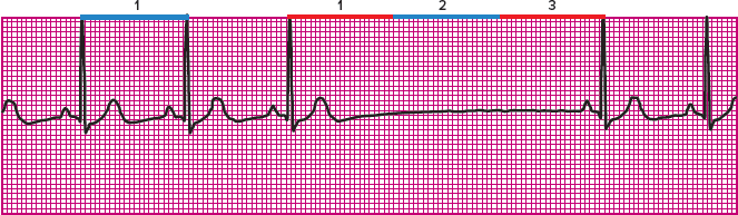 <p>Which rhythm is this?</p>