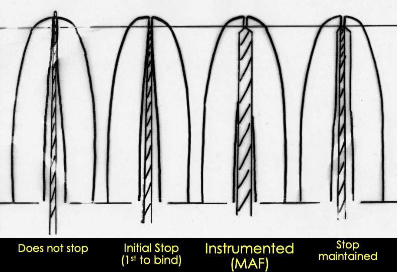<p>What are the steps for maintaining the apical stop?</p>
