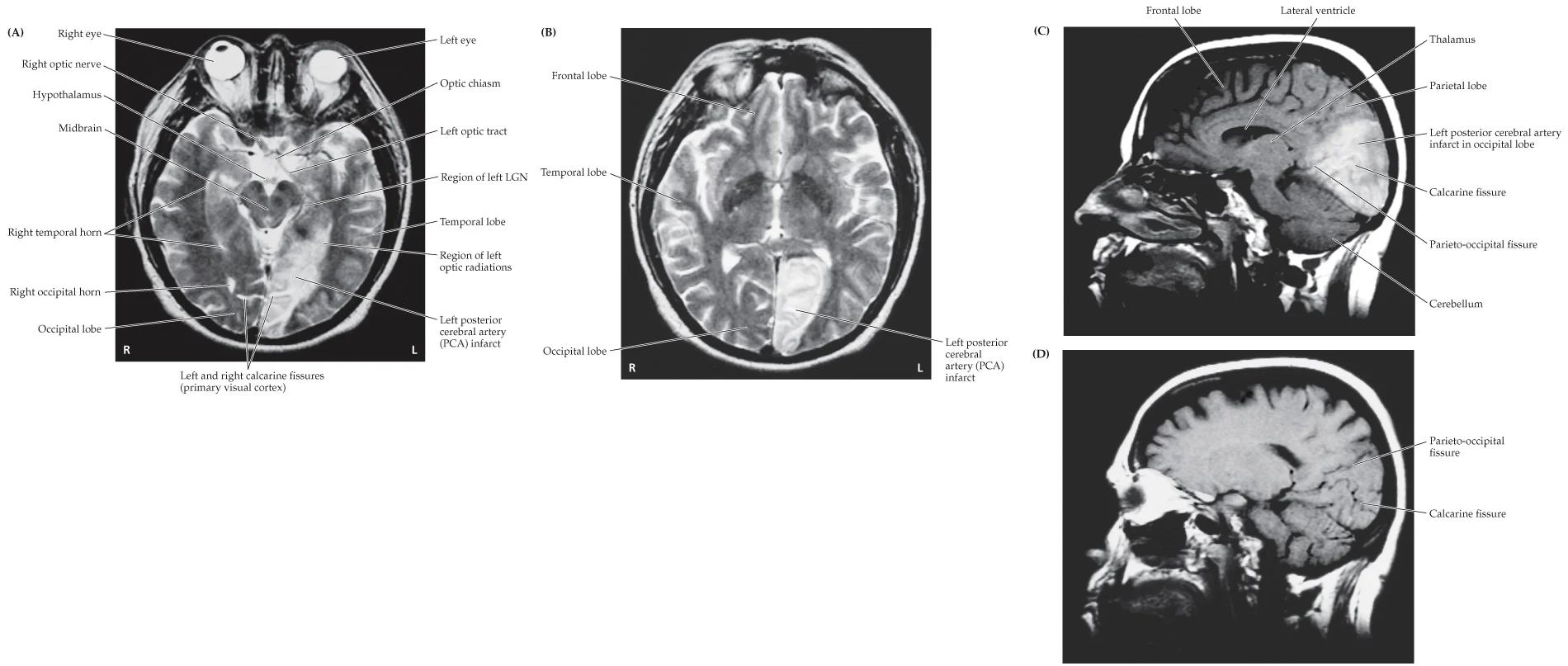 <p>Left PCA infarct</p>