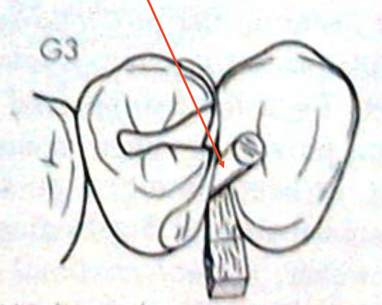 <p>used to close gingival gap found on maxillary first premolar caused by mesial root fluting</p>