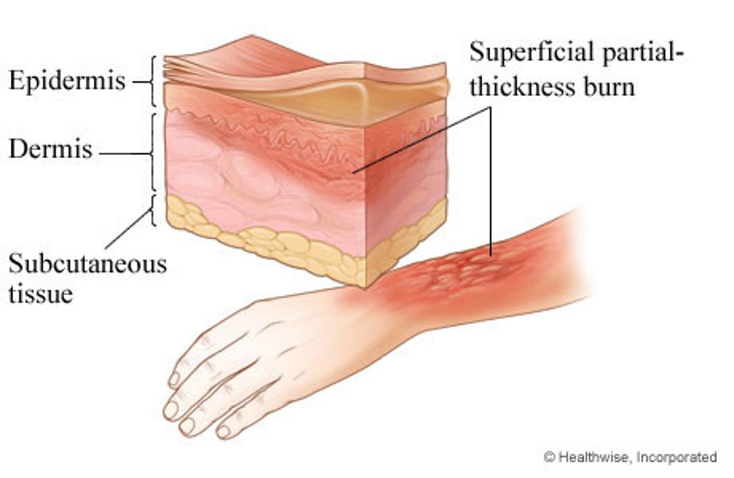 <p>only epidermis affected; redness and pain; no blisters or swelling occurs</p>