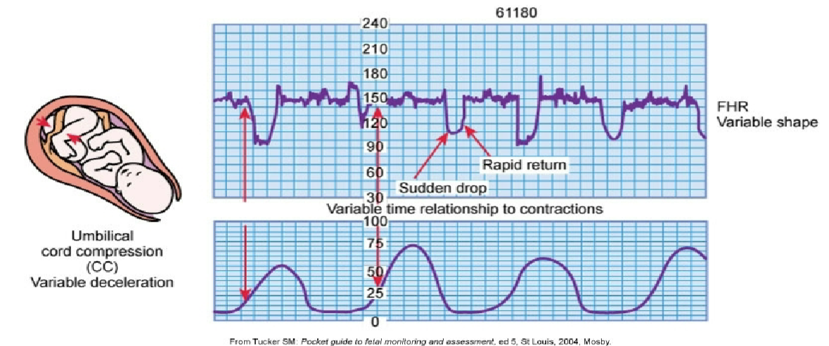 <p>slowing of FHR of 15 bpm or more below baseline for at least 15 seconds</p>