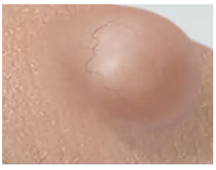 <p>What kind of lesion is this?</p>