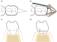 <p>Chromic gut or Vicryl; no suture placed between buccal and lingual flaps.</p><p>(Explanation: Chromic gut and Vicryl are absorbable, suitable for distal wedge areas where sutures don't need to hold flaps together tightly, as the procedure often leaves an open wound that heals by secondary intention.)</p>