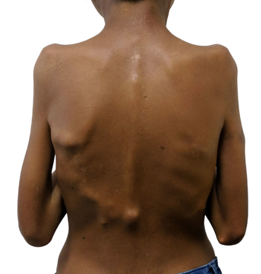<ul><li><p>rare gene mutation that causes deposition of bone around skeletal muscles and soft tissues</p></li><li><p>no effective treatment </p></li><li><p>painful/debilitating</p></li><li><p>patients rarely live into the 40’s</p></li></ul><p></p>