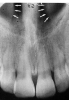 <p>Inferior Nasal Conchae</p>