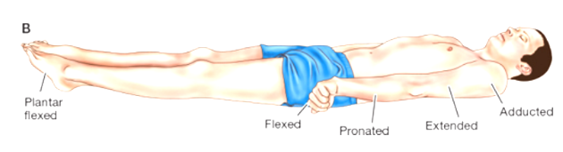<p>involves extreme extension of the upper and lower extremities and <strong>indicates severe damage to the brain at the lower midbrain and upper pons</strong></p>