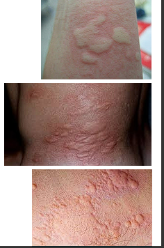 <ul><li><p>Transient papules or plaques, often called hives/wheals </p></li></ul><ul><li><p>Possible angioedema/anaphylaxis</p></li><li><p>EX: Insect bite reactions, angioedema</p></li></ul><p></p>