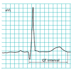 <p>▪ QT intervals atspoguļo kambaru</p><p>depolarizāciju un repolarizāciju</p><p>▪ QT = 350 - 450 ms</p><p>▪ Ilgums atkarīgs no sirds darbības</p><p>frekvences</p>
