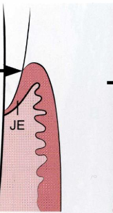 <p>stage of passive eruption: The most apical limit of the epithelial</p><p>attachment is at the cementoenamel junction</p>