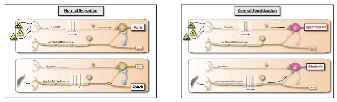 <ul><li><p>Amplification of neural signaling (e.g., nociceptive information) within the CNS that elicits pain hypersensitivity or even normal stimuli (allodynia)</p><ul><li><p>Changes in the synapses and potentially the organization of interconnecting neurons may increase excitability/reducing inhibition of pain pathways</p></li><li><p>Contributions are difficult to identify and treatments difficult to target</p></li></ul></li></ul><p></p>