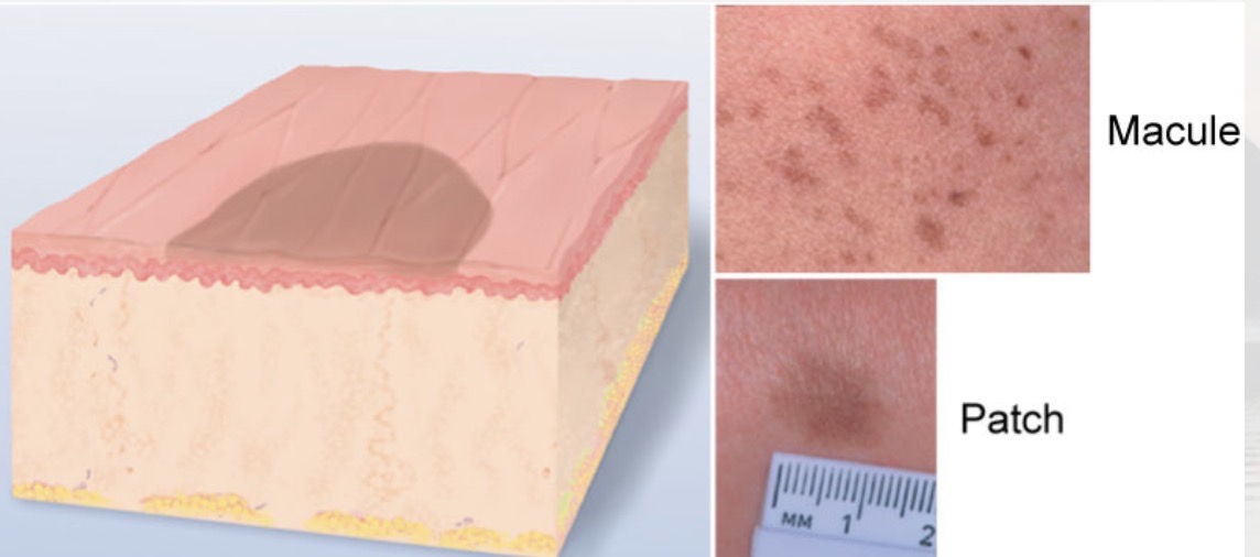 <p>Macule: flat (freckle) </p><p>Patch: vitiligo </p>